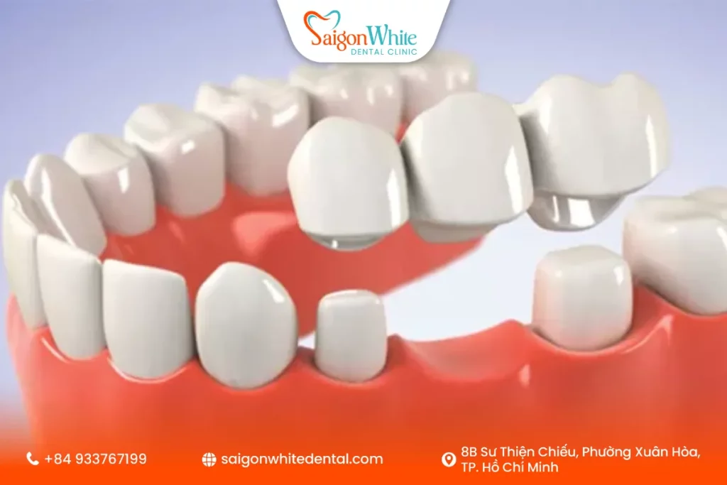 Phục hình Cầu răng sứ