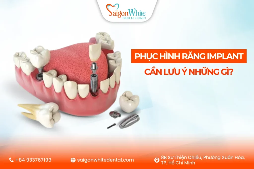 Phục Hình Răng Implant Cần Lưu Ý Những Gì?