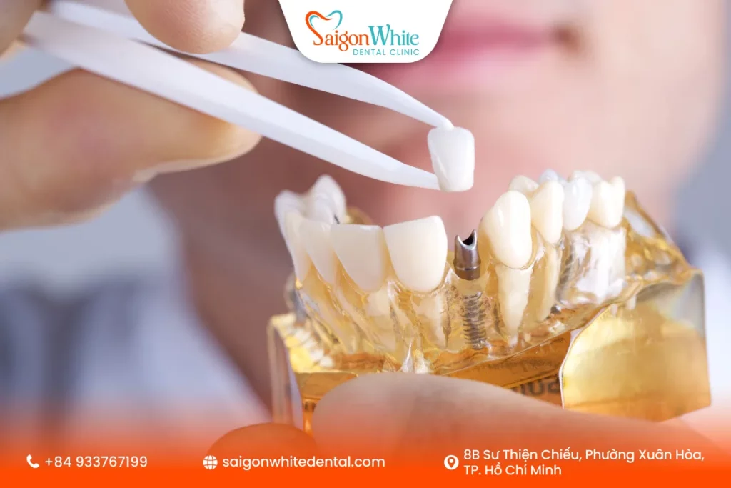 Phục hình cấy ghép implant