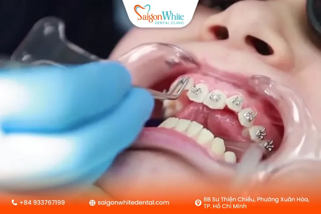 Quy trình niềng răng tăng trưởng chuẩn tại các nha khoa uy tín
