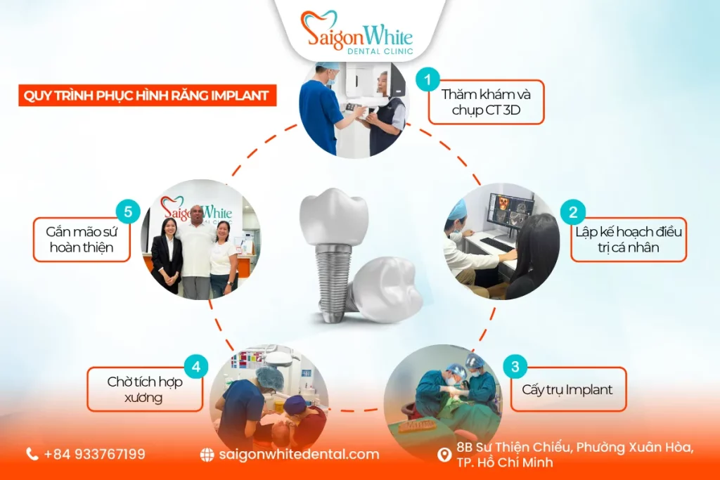 Quy trình phục hình răng Implant tại nha khoa