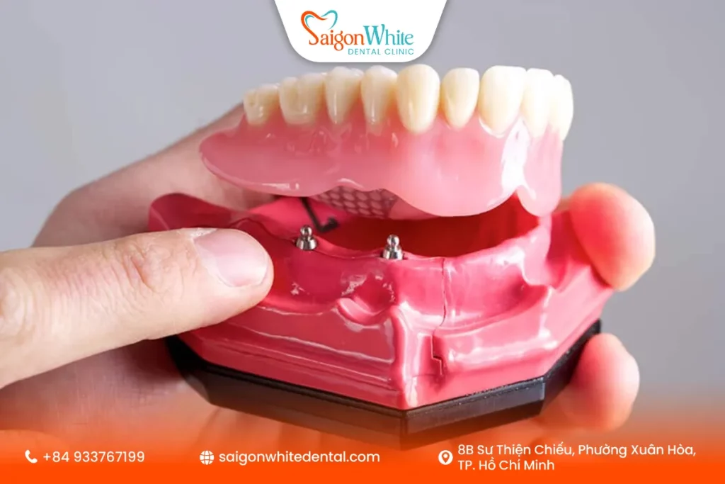 Răng giả tháo lắp trên Implant (Implant-supported Denture)