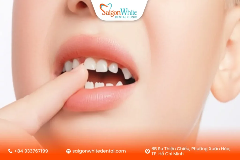 Răng sữa lung lay lâu ngày nhưng không rụng