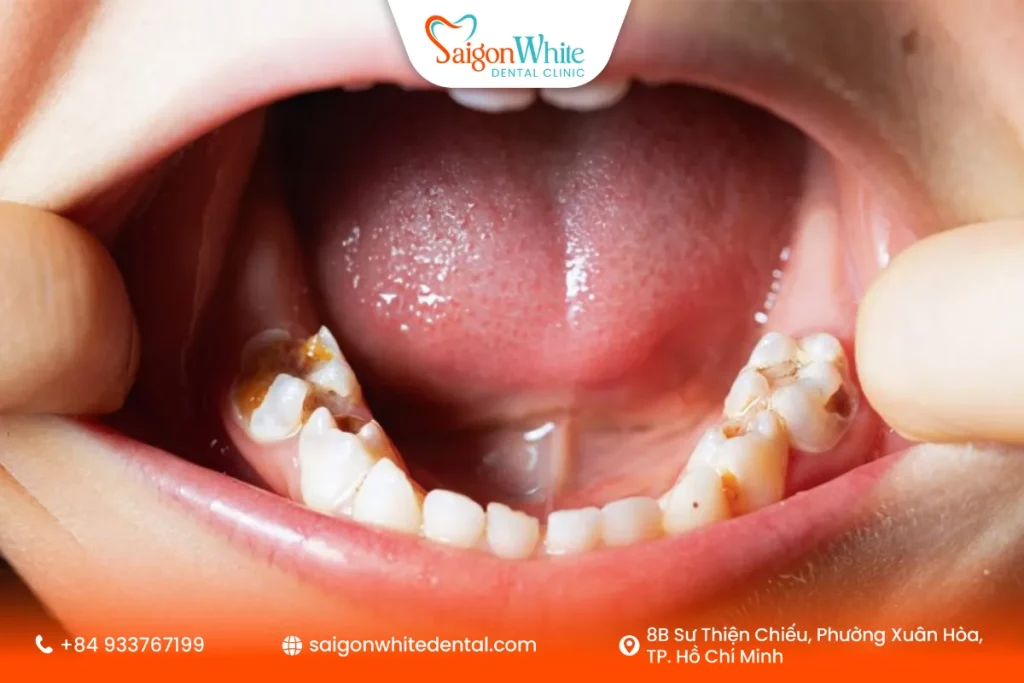 Răng sâu nặng sẽ thay răng sớm