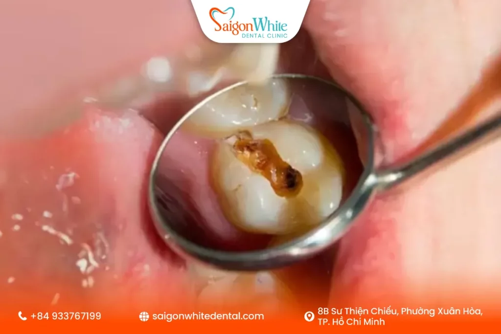 Sâu răng khi răng mọc sai vị trí