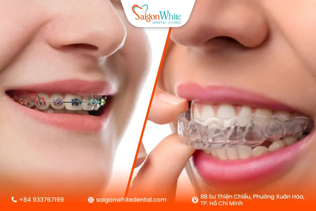 So sánh niềng răng trong suốt và niềng răng mắc cài
