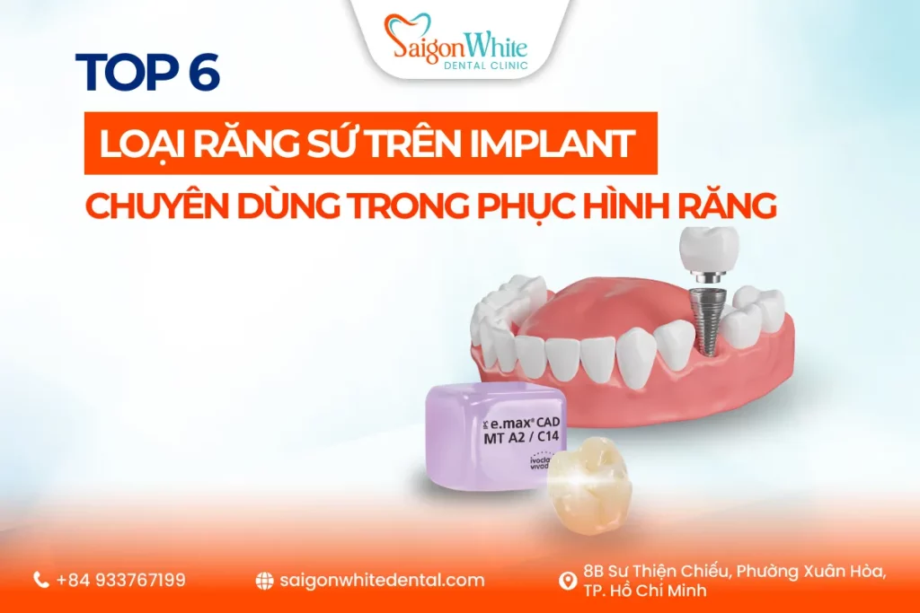Top 6 loại răng sứ trên Implant chuyên dùng trong phục hình răng