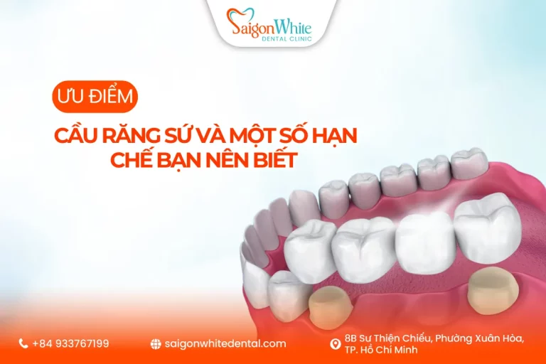 Ưu điểm cầu răng sứ và một số hạn chế bạn nên biết