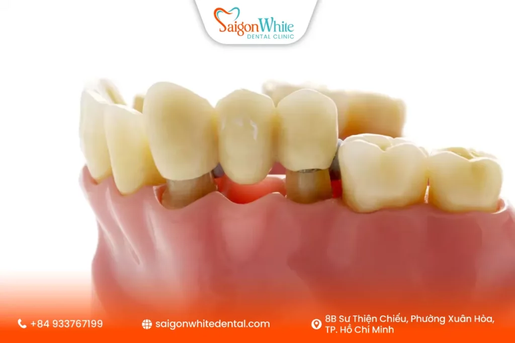 Ưu điểm của cầu răng sứ