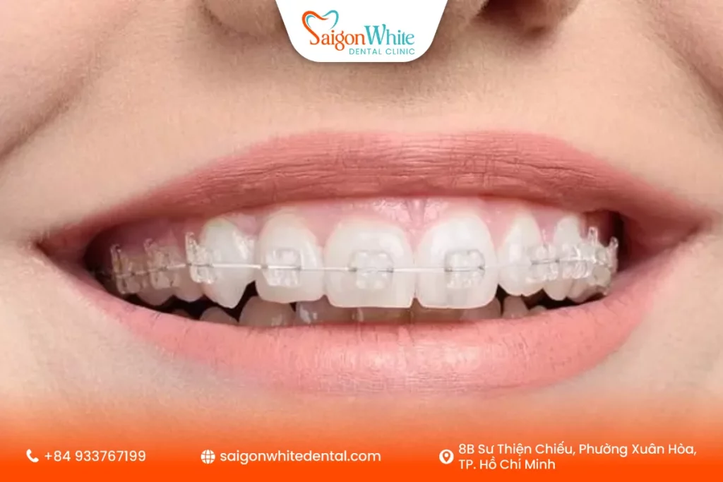 Ưu điểm của mắc cài sứ