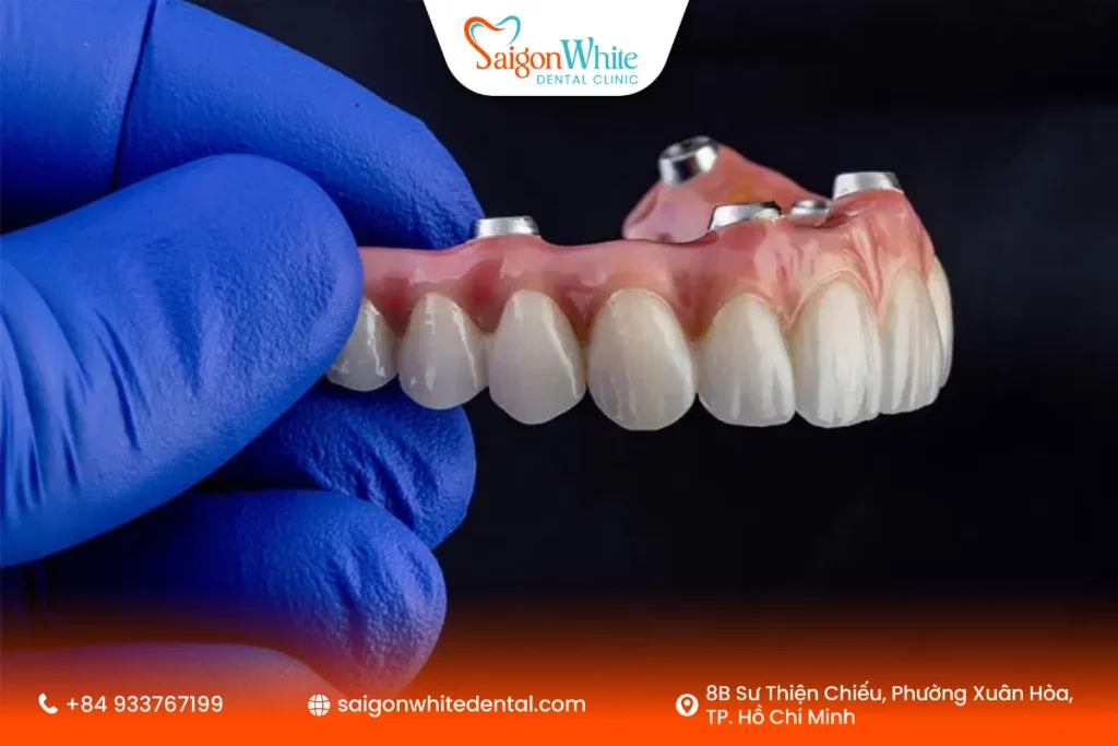 Những người mất răng toàn hàm rất phù hợp để làm all-on-4