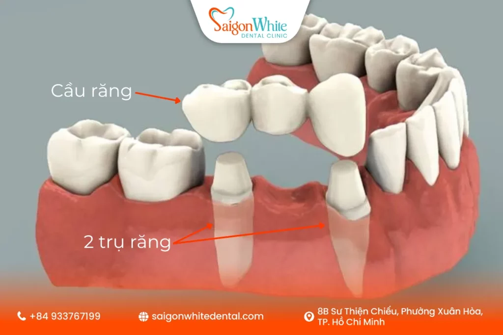 Làm cầu răng sứ là gì? Vai trò của cầu răng trong phục hình răng mất
