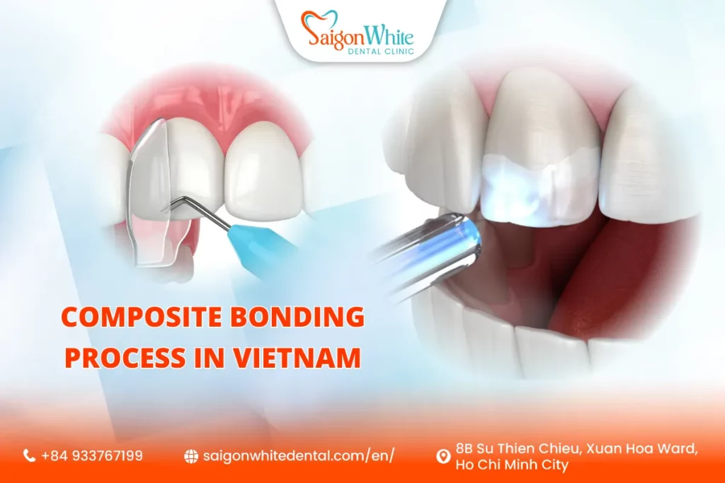 Professional Composite Bonding Process in Vietnam