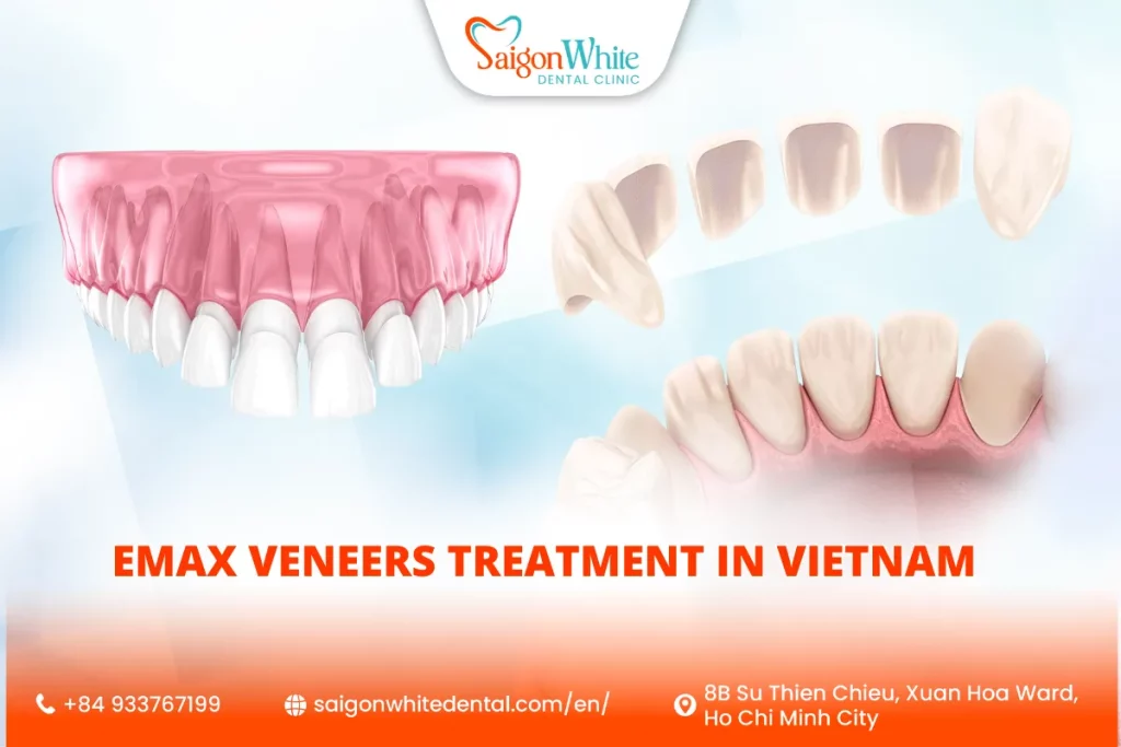 Emax Veneers Treatment in Vietnam