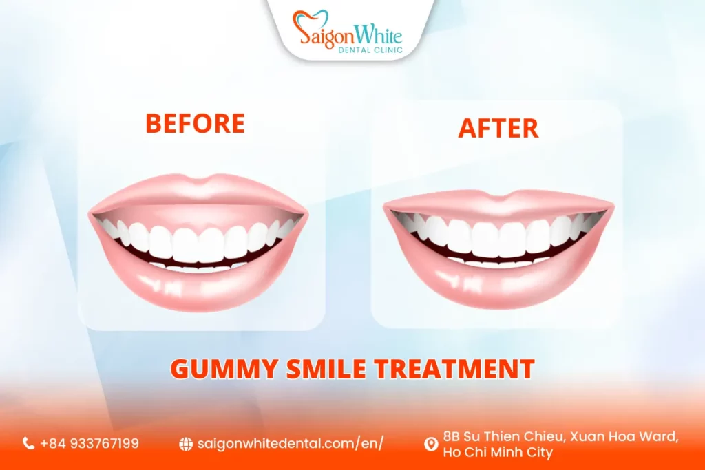 Gummy Smile Treatment in Vietnam: