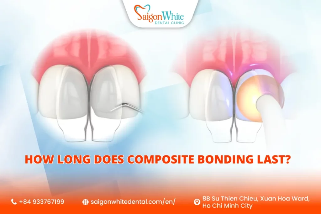 How Long Does Composite Bonding Last?