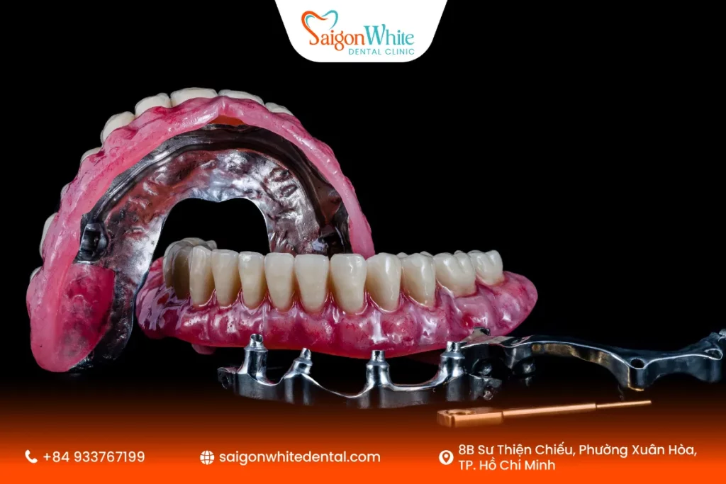 Quy trình trồng răng implant all-on-4