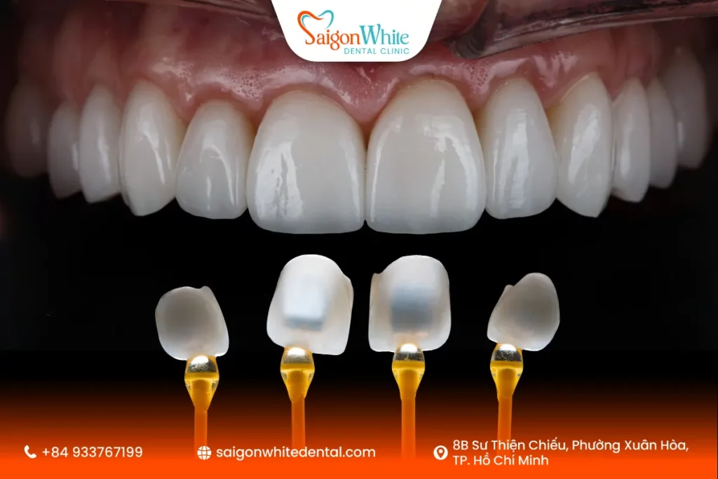 Ai phù hợp với dán sứ Veneer không mài răng?