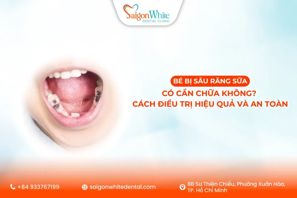 Bé bị sâu răng sữa có cần chữa không? Cách điều trị hiệu quả và an toàn