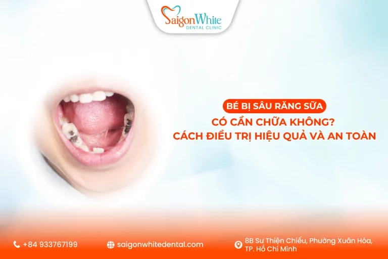 Bé bị sâu răng sữa có cần chữa không? Cách điều trị hiệu quả và an toàn