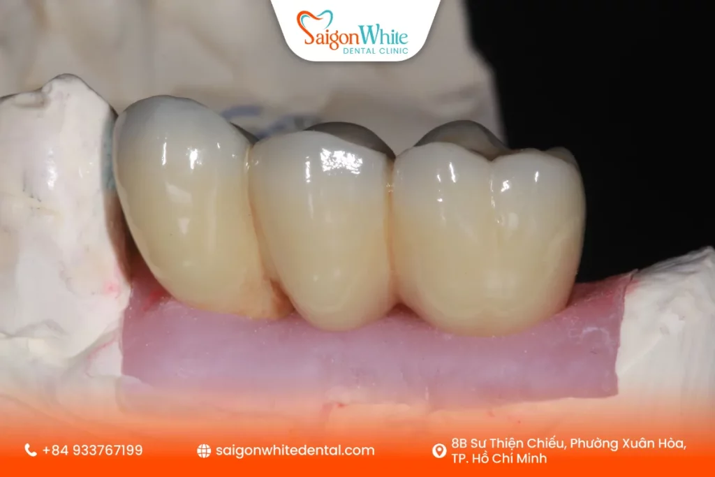 Cầu răng sứ là gì? Khi nào nên làm cầu răng sứ?