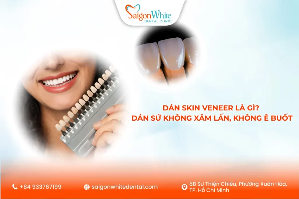 Dán skin veneer là gì? Dán sứ không xâm lấn, không ê buốt