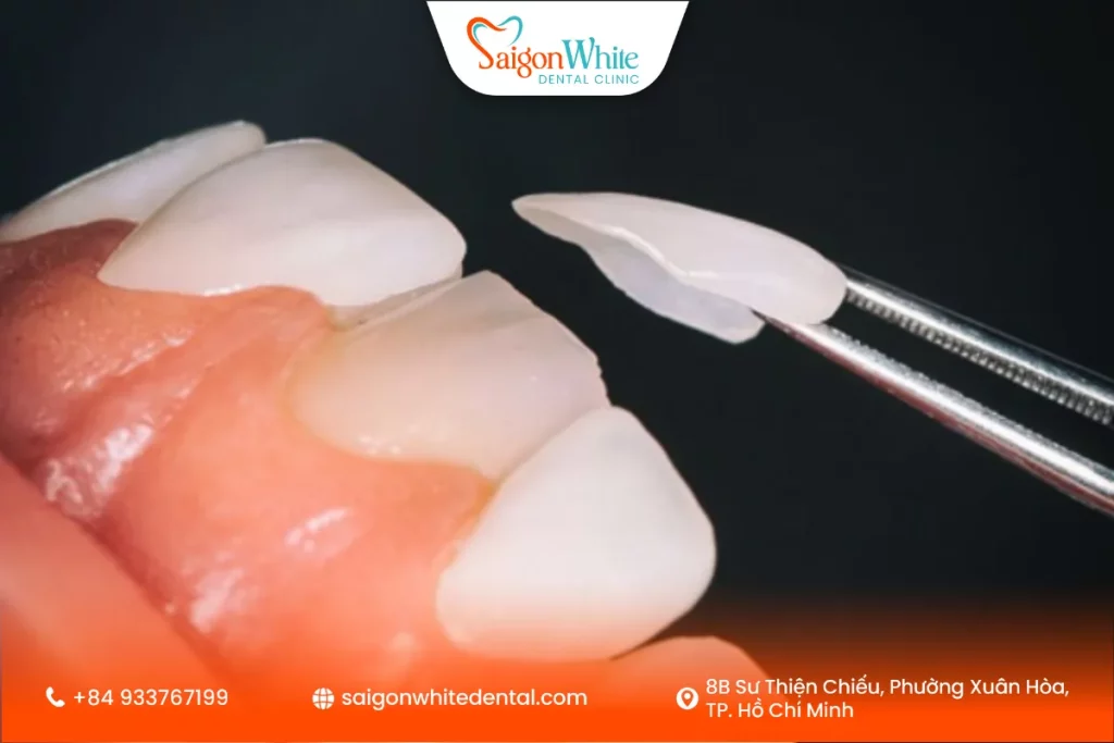 Dán skin Veneer là gì?