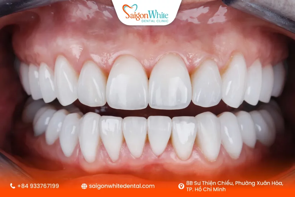 Dán sứ Veneer không mài răng là gì?