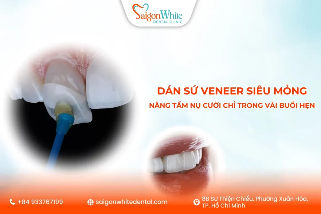 Dán sứ Veneer siêu mỏng: Nâng tầm nụ cười chỉ trong vài buổi hẹn