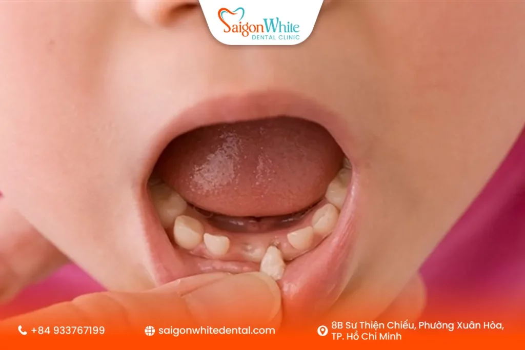 Dấu hiệu nhận biết trẻ sắp thay răng sữa