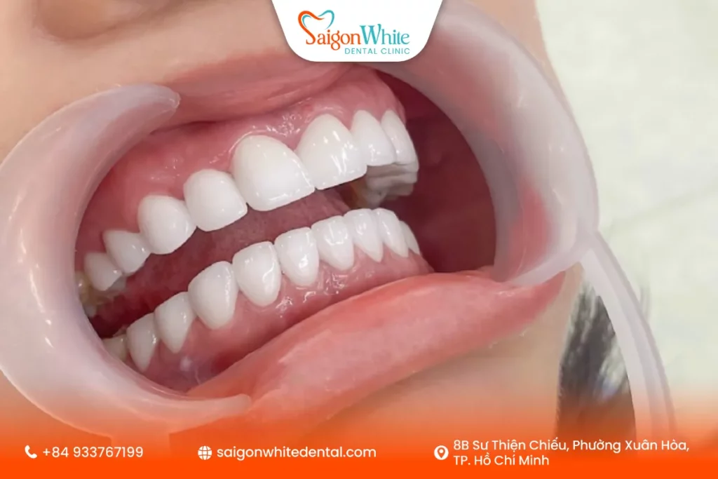 Những lưu ý khi bọc răng sứ