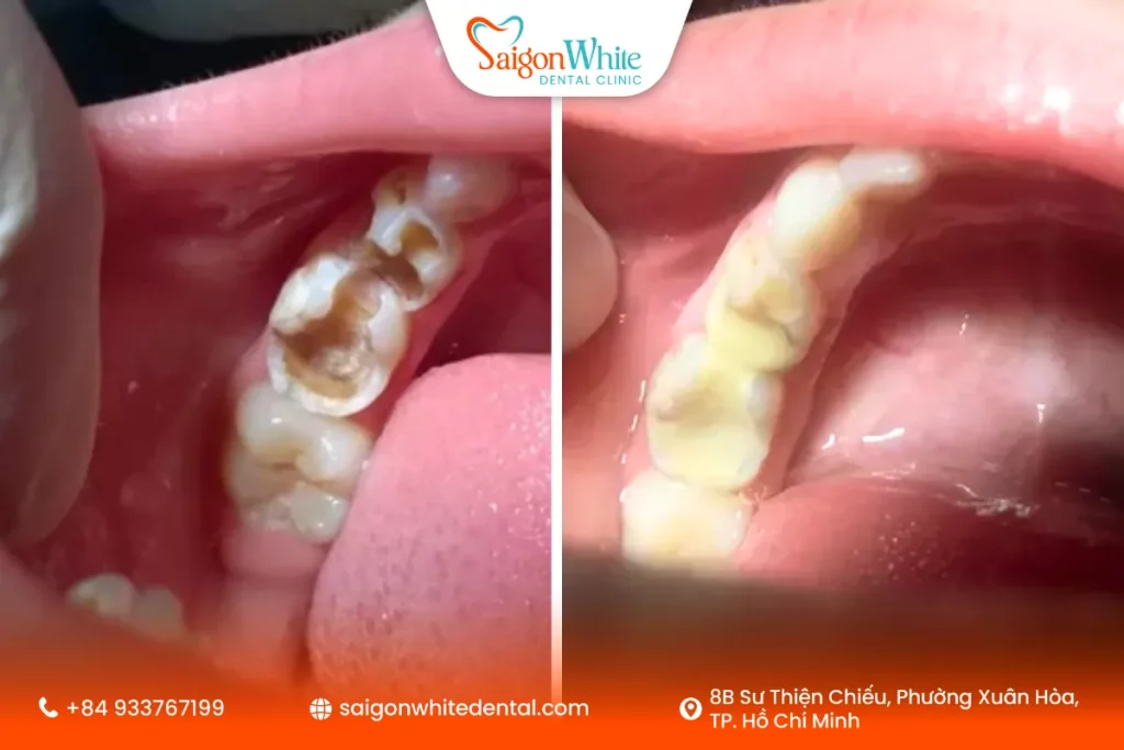 Trám răng là phương pháp phổ biến khi trẻ bị sâu răng