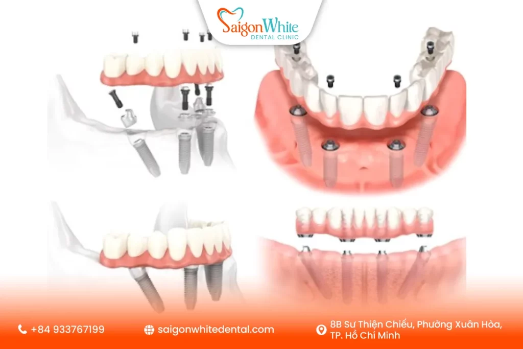 Trồng răng implant all-on-4 là gì?