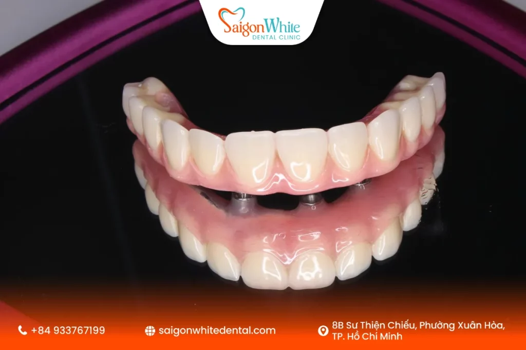 Chỉ cần 4 trụ Implant cho cả hàm, chi phí thấp hơn nhiều so với cấy từng răng.