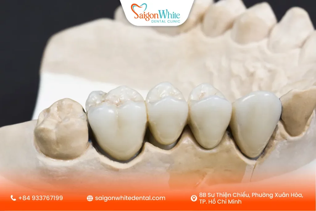 Ưu điểm nổi bật của cầu răng sứ