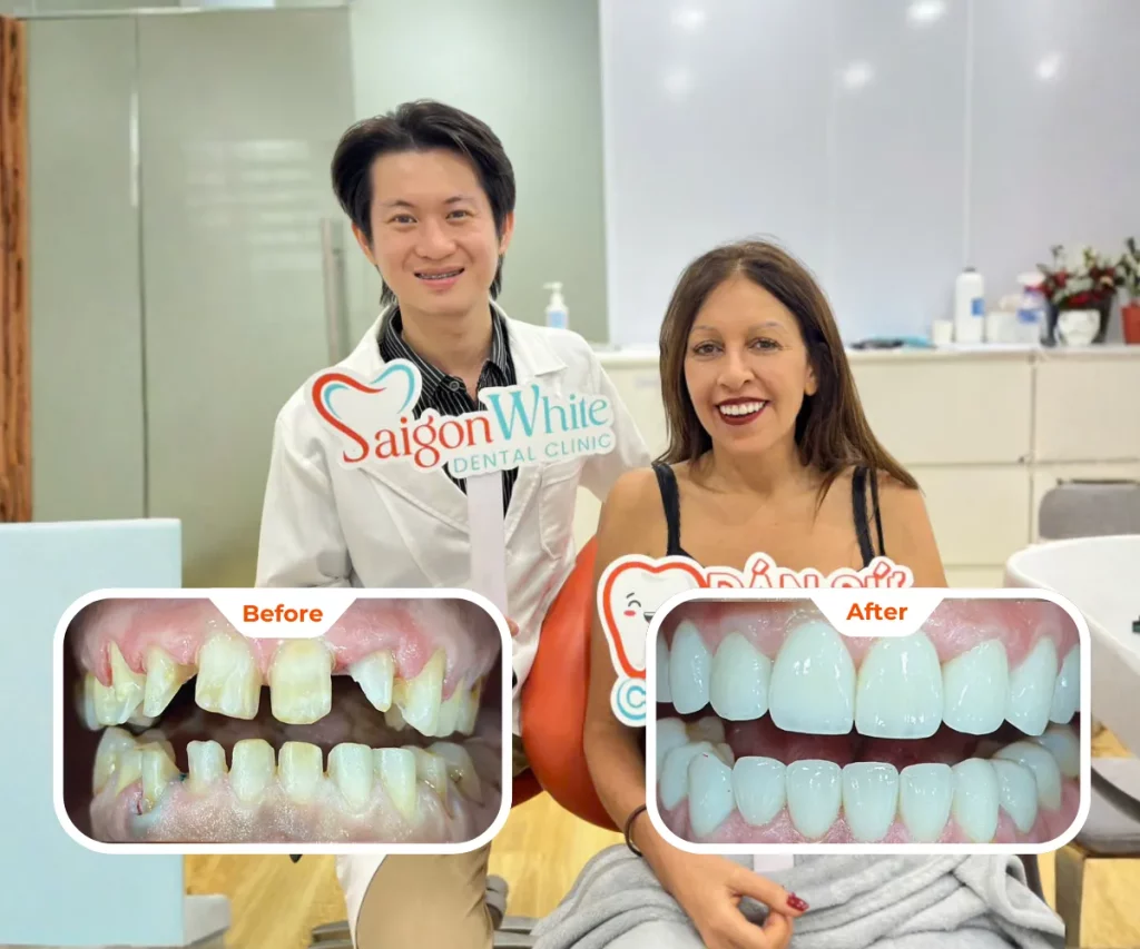 Before & After Photos of Veneer Treatment at Saigon White Dental Clinic