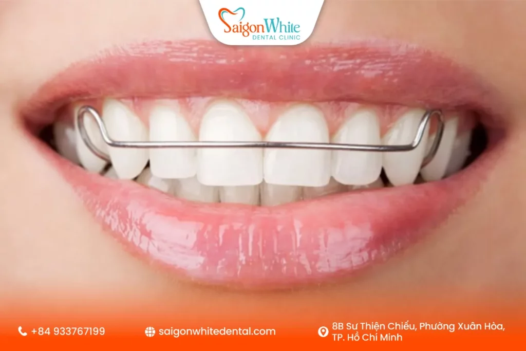 Hàm duy trì Hawley (hàm kim loại)