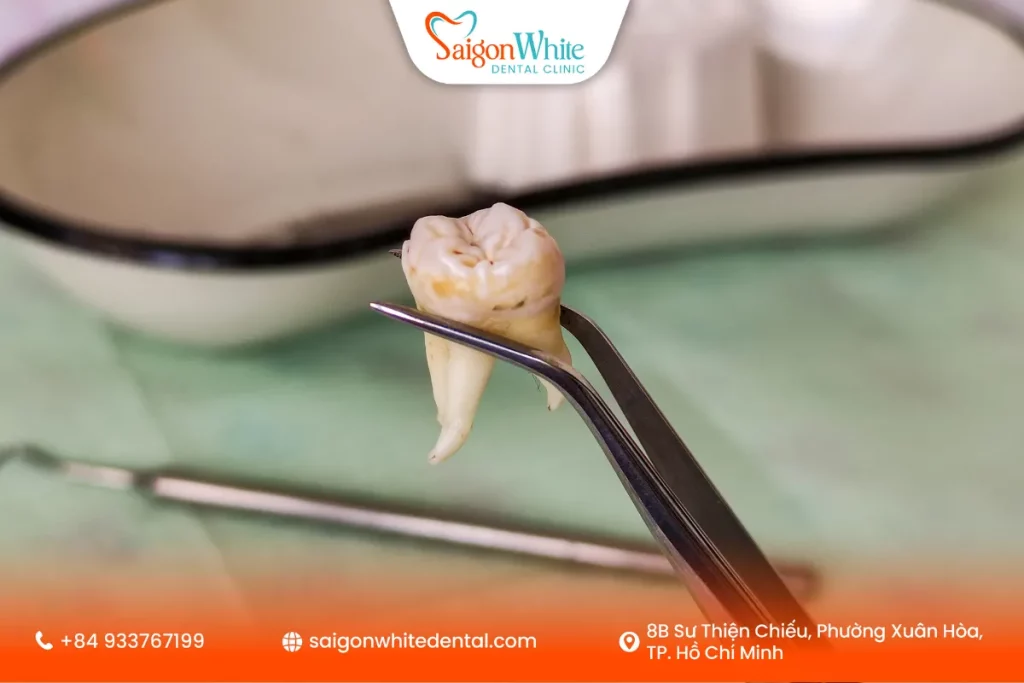 Nhổ 4 răng khôn cùng lúc có đau không?