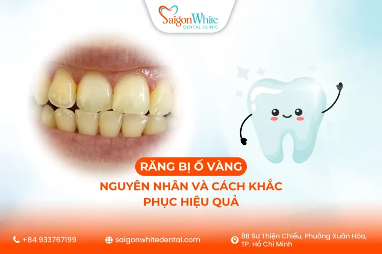 Răng Bị Ố Vàng: Nguyên Nhân Và Cách Khắc Phục Hiệu Quả