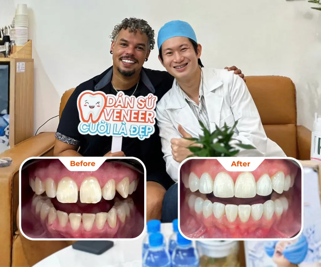 Before & After Photos of Veneer Treatment at Saigon White Dental Clinic