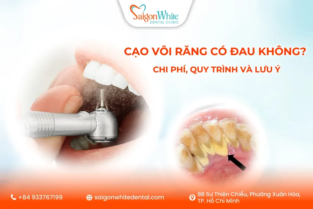 Cạo Vôi Răng Có Đau Không? Chi Phí, Quy Trình và Lưu ý 