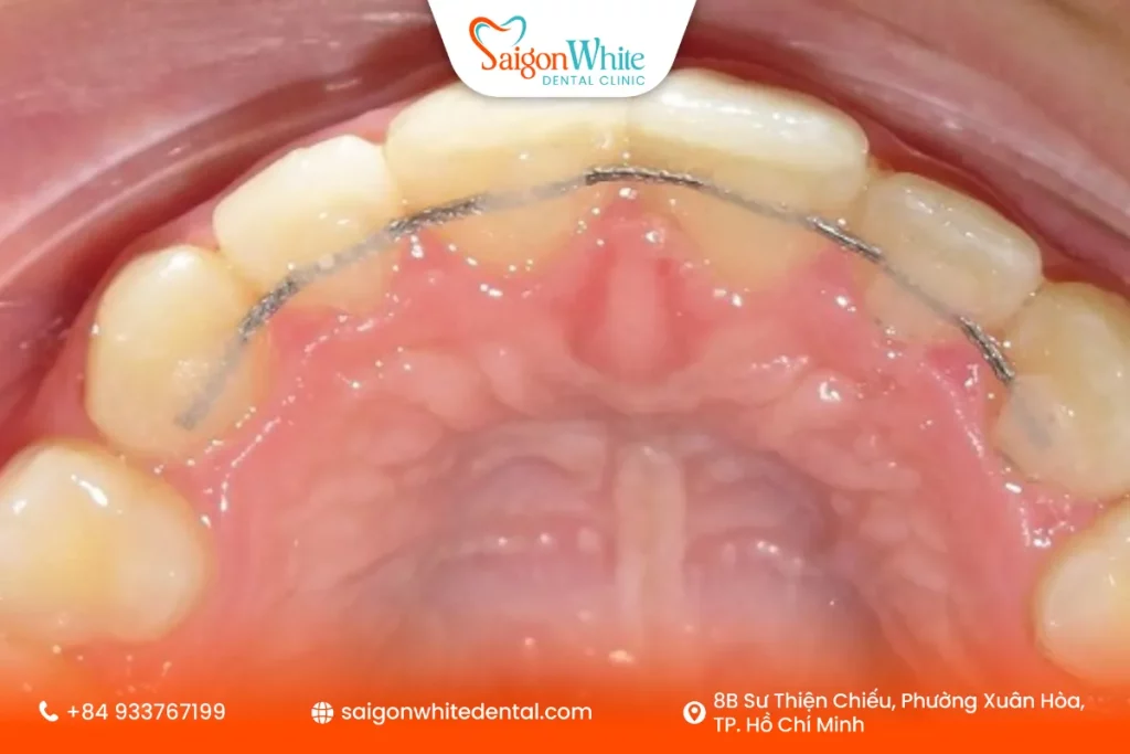 Hàm duy trì cố định