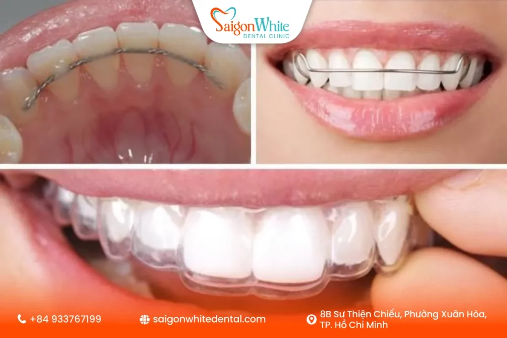 Hàm duy trì sau khi niềng răng là gì?