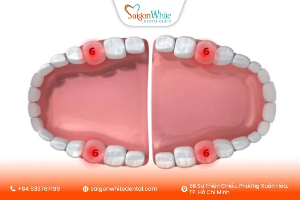 Mất răng số 6 là gì?