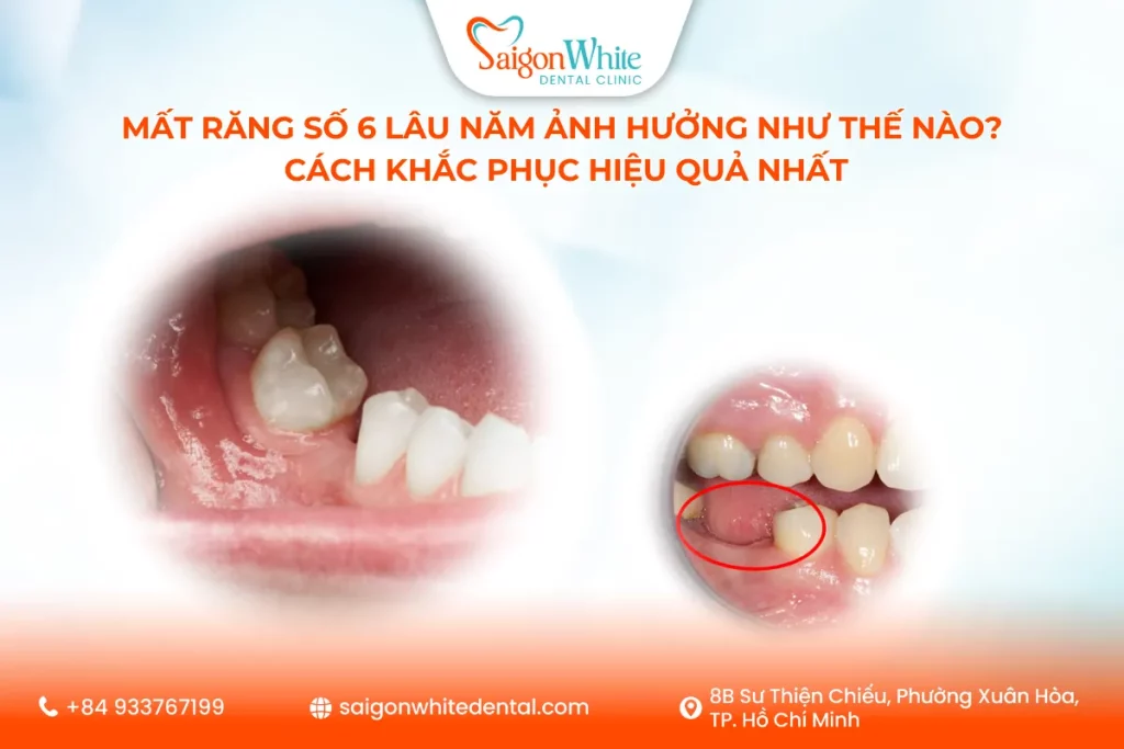 Mất Răng Số 6 Lâu Năm Ảnh Hưởng Như Thế Nào? Cách Khắc Phục Hiệu Quả Nhất