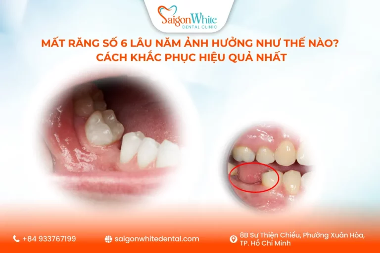 Mất Răng Số 6 Lâu Năm Ảnh Hưởng Như Thế Nào? Cách Khắc Phục Hiệu Quả Nhất