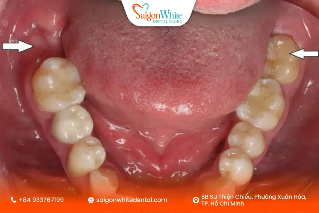 Mất răng số 7 có niềng được không?