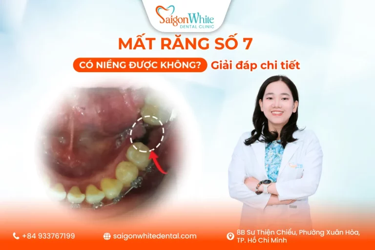 Mất Răng Số 7 Có Niềng Được Không? Giải Đáp Chi Tiết