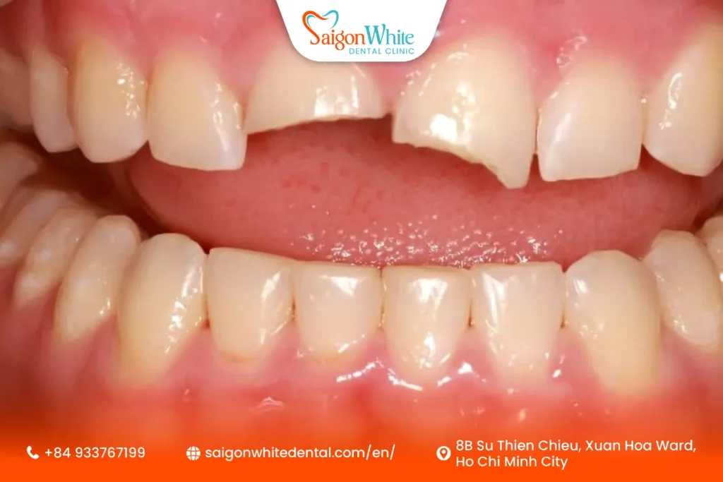 Nguyên nhân thường gặp gây gãy răng cửa