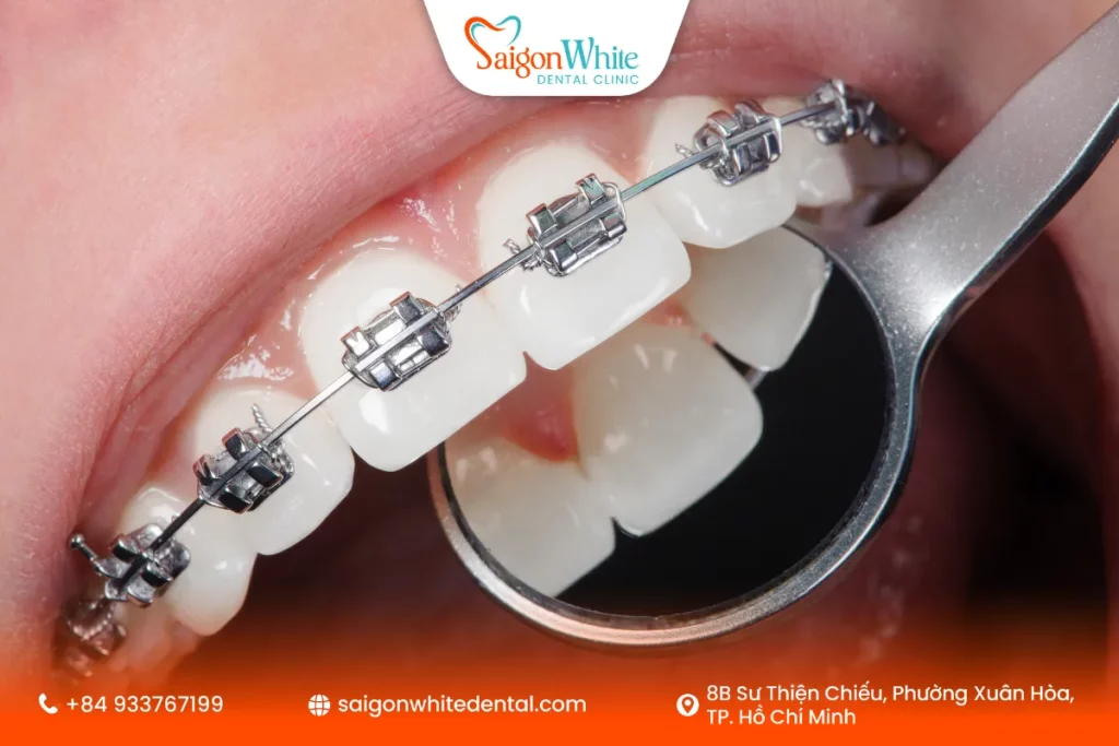 Niềng răng 1 hàm có hiệu quả không?